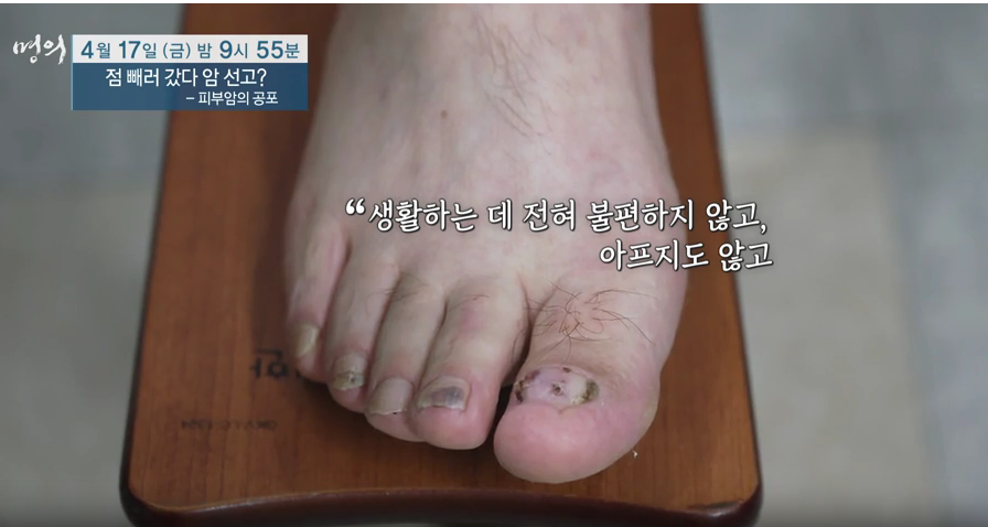 명의 피부암 점 구별법