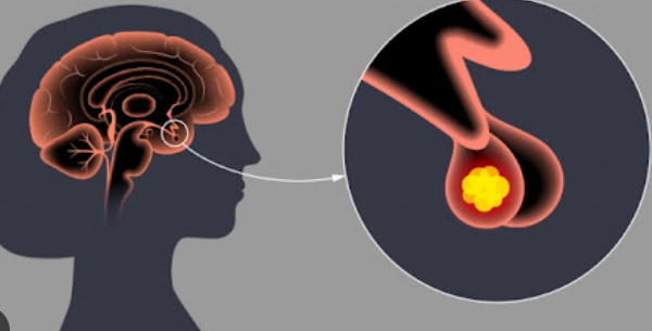 뇌하수체 종양 증상과 치료방법