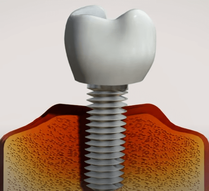 임플란트 주위염 ; 증상, 원인, 예방 및 관리방법 알아보기(재수술, 부작용, 재식립)