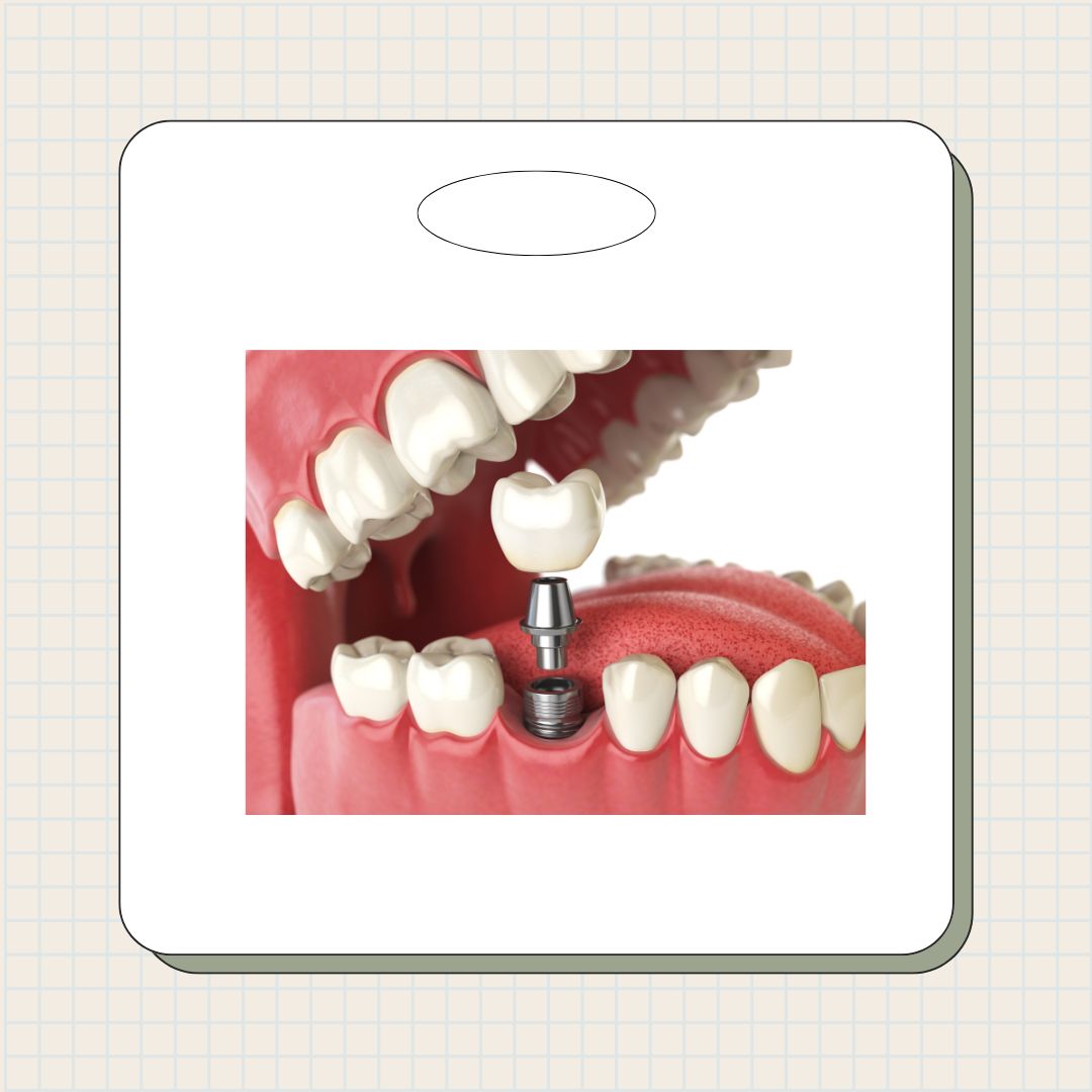 노인임플란트 국가지원