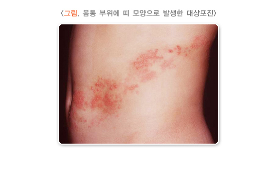 대상 포진 초기
