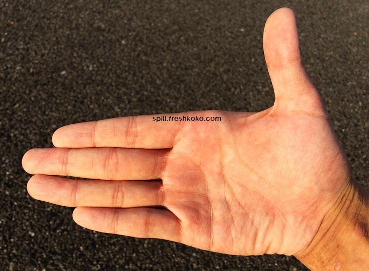 류마티스 관절염 초기증상