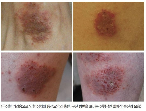 습진 가려움 집에서 응급 처치하는 방법