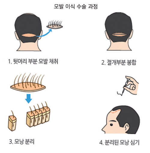 모발이식 3000모 비용