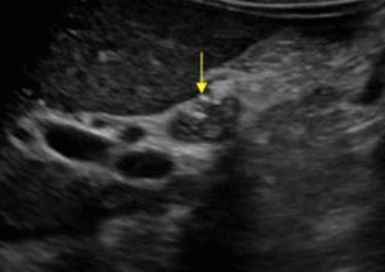 담관염(Cholangitis)