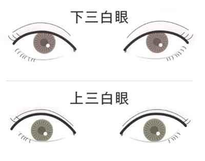 삼백안 눈의 형태