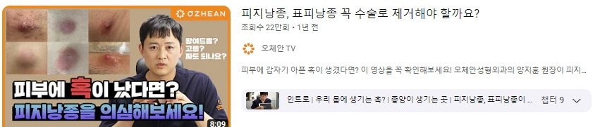 유튜브의 피지낭종 고민 영상입니다