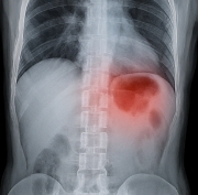 혈뇨가 나오는 이유