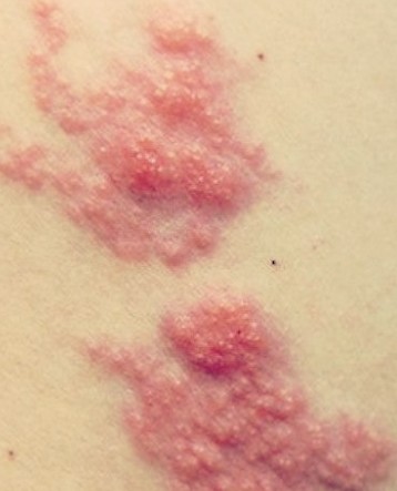 대상포진 치료방법