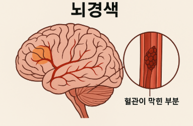 뇌경색 초기증상 및 뇌경색 원인 최종 정리본!
