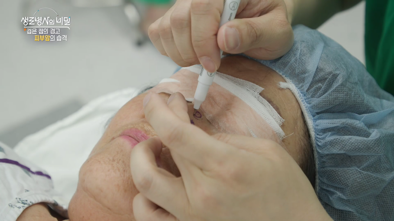 생로병사의 비밀 피부암 검은점