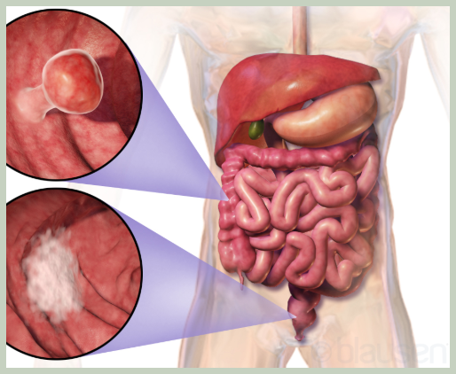혈변의 원인 중 대표적 질병