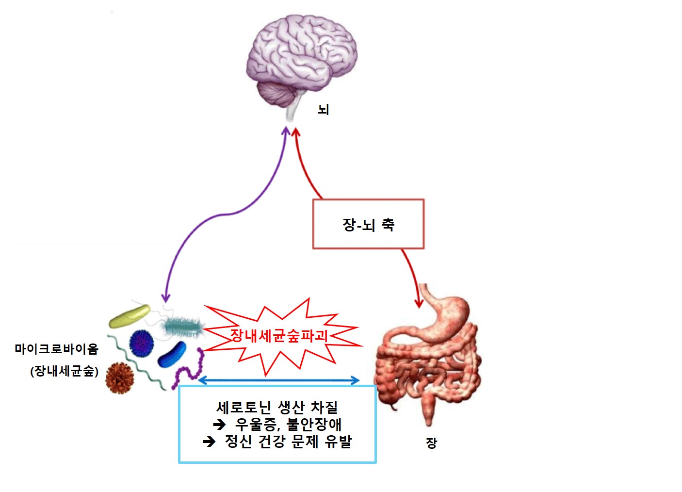 과민성대장증후군