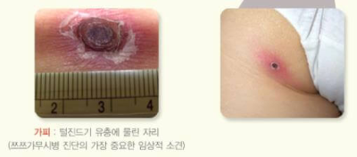 쯔쯔가무시_가피