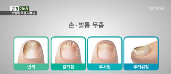 손발톱 무좀
