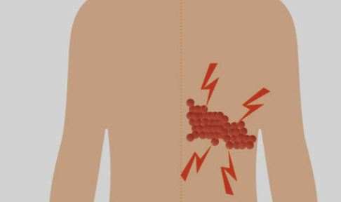 대상포진 초기증상 치료방법 예방법 총정리
