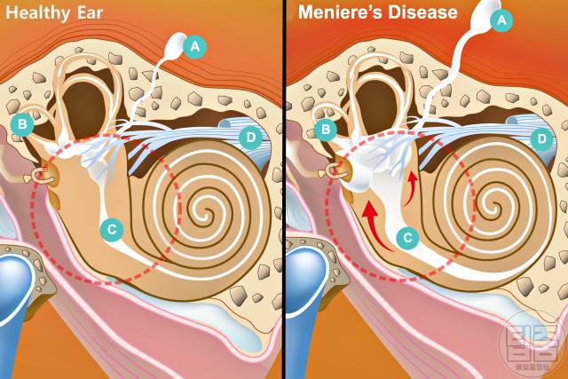 어지럼증 원인 귓병 어지러움 원인 메니에르병