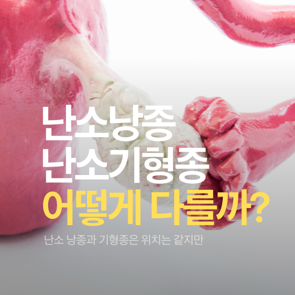 난소 낭종과 기형종, 어떻게 다를까?