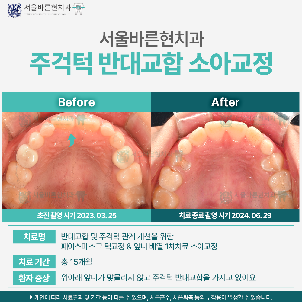 부산소아교정