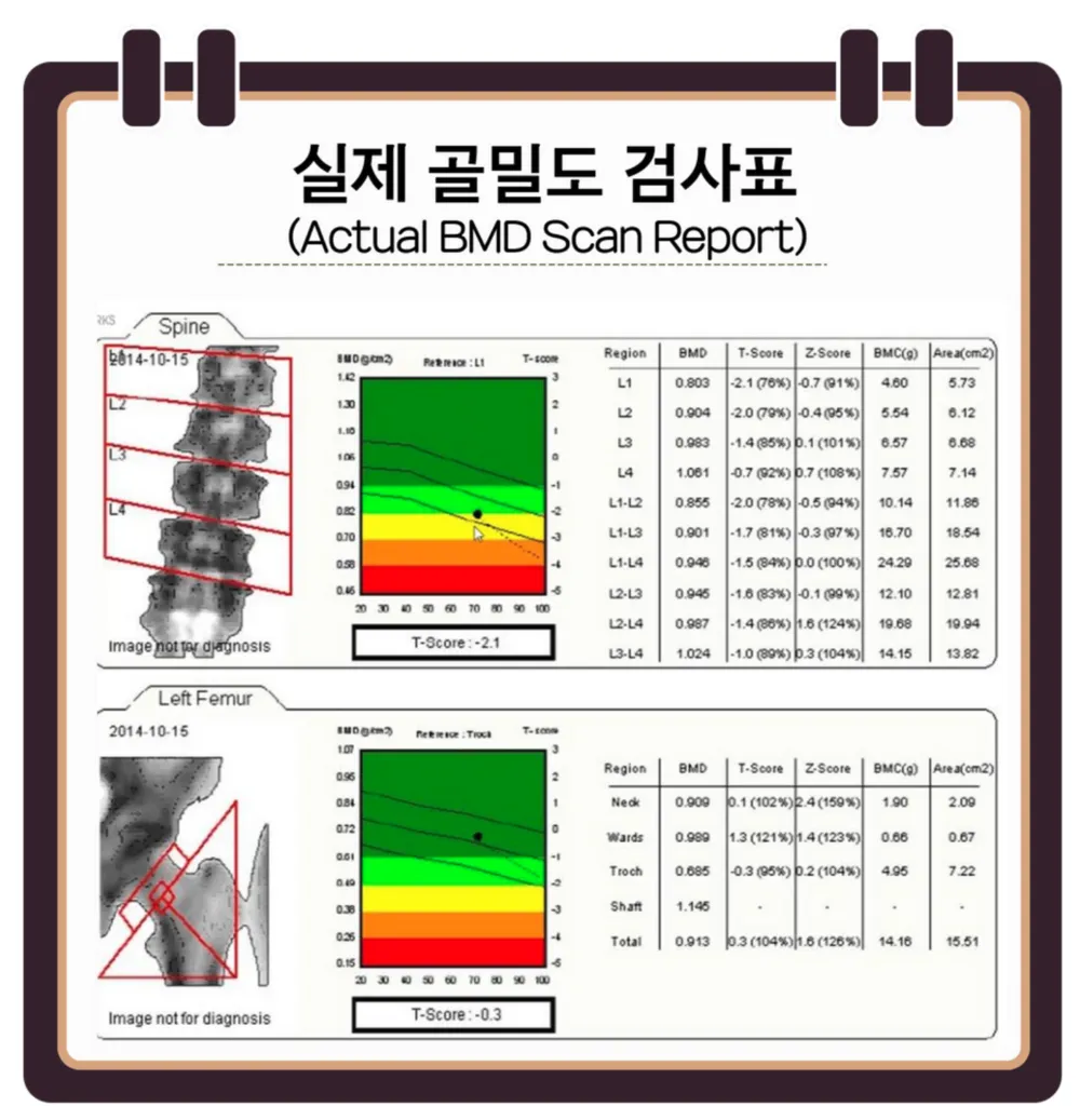 골밀도 검사 수치 골밀도 높이는 방법 간단 정리_7