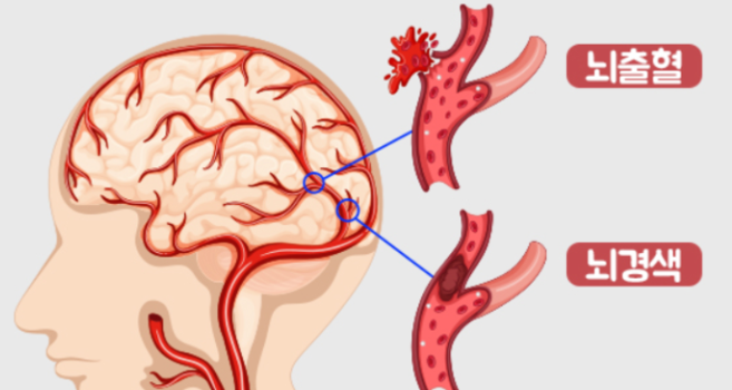 뇌출혈 전조증상