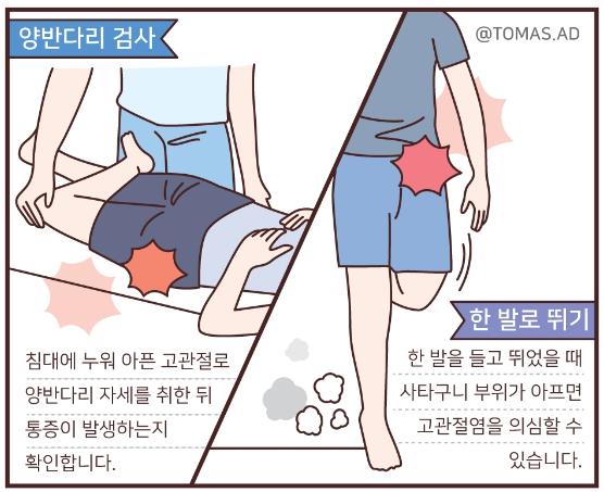 고관절 통증 증상 1