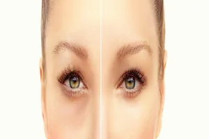 상안검-수술-비용