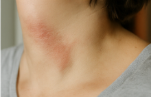 대상포진초기증상