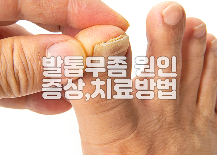 발톱무좀으로 발톱이 두껍고 갈라져 있다