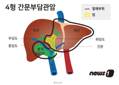 담도암이란? 정의와 종류