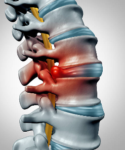 허리디스크 회복 운동법