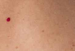 피부 붉은점 흔한 원인