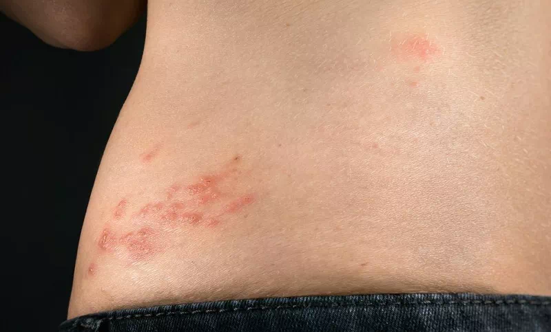 수포없는 대상포진