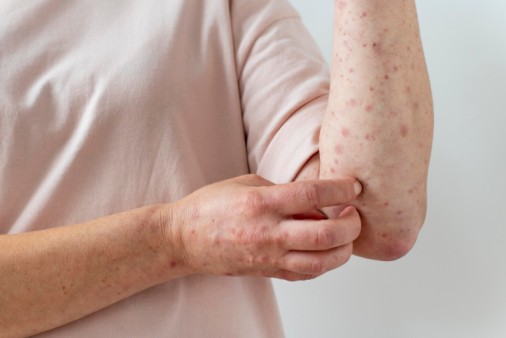 대상포진 - 백신 종류별 효과