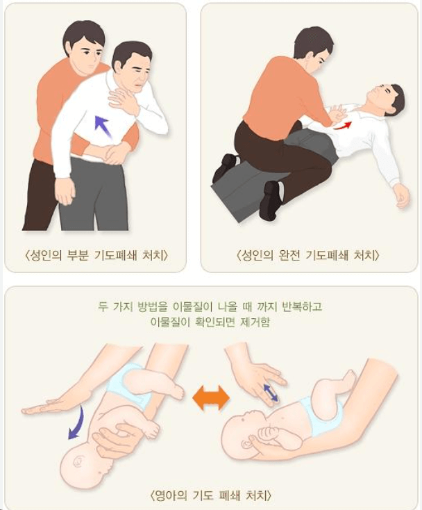 하임리히법