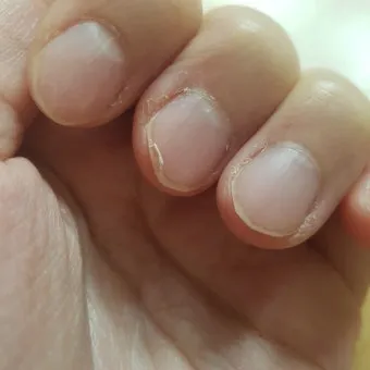 손톱이 갈라지는 이유 원인 증상 대처법_2