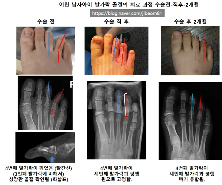성장판 닫혀도 키 클 수 있는 방법과 성장 호르몬 시기_2