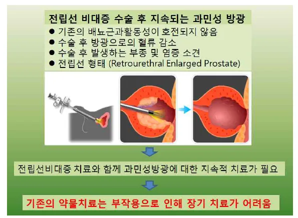 전립선비대증 치료