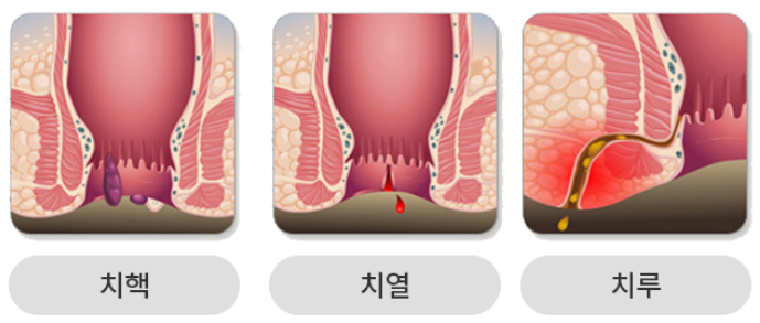 치질의 3가지 종류 출처 보건복지부 대한의학회
