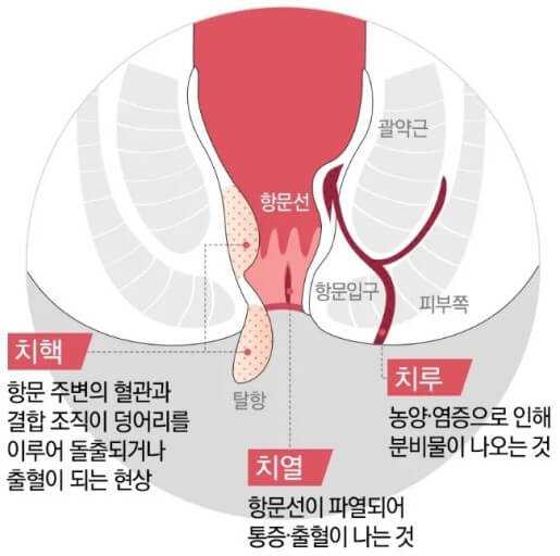 치질의 모양