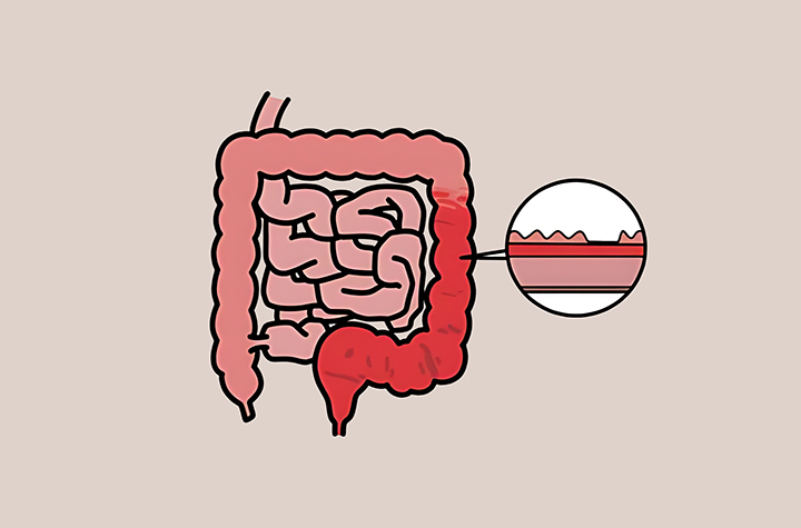 암이-발견된-대장의-모습