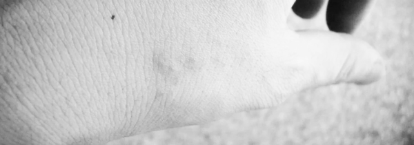 빈대 물린자국: 증상