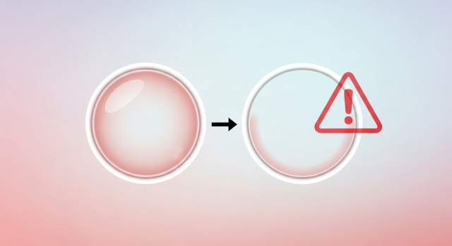 정상 각막과 얇은 각막을 비교해 보여주는 인포그래픽