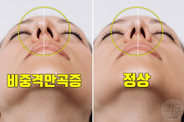콧물 목 뒤로 넘어가요 후비루 원인 비중격만곡증