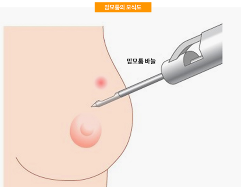 맘모톰 수술 총정리