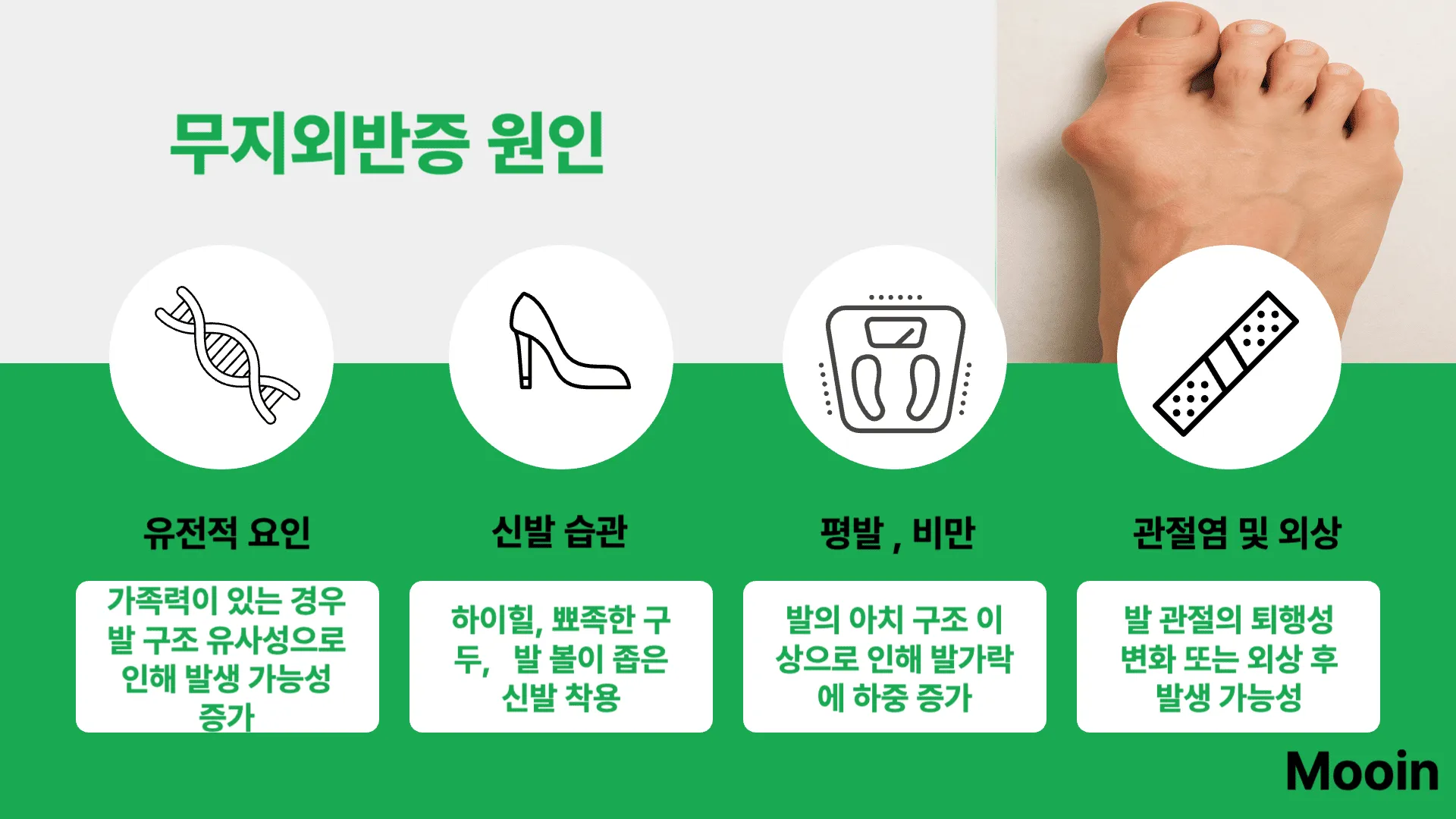 무지외반증 원인