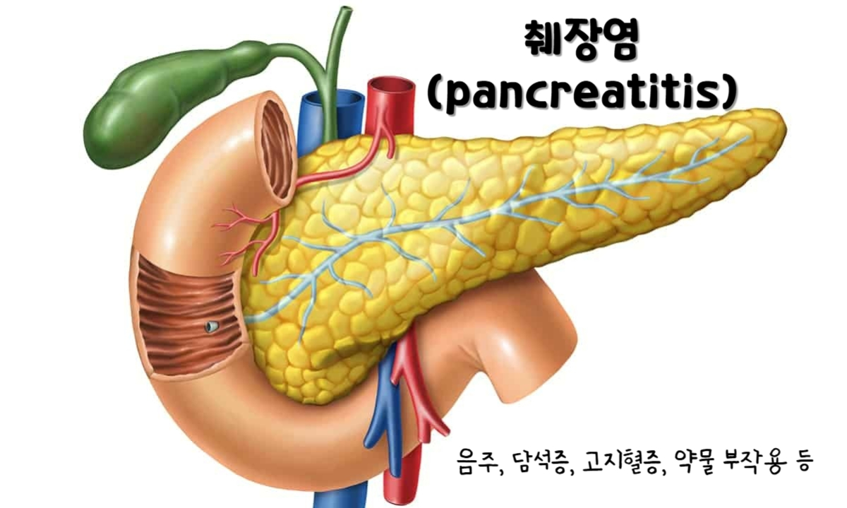췌장염(pancreatitis)
췌장염의 주요 원인 : 음주, 담석증, 고지혈증, 약물 부작용 등