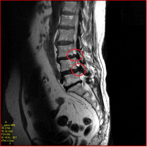 척추관 협착증 사진