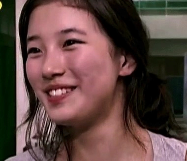 임플란트 후 교정 김태희 수지 효과