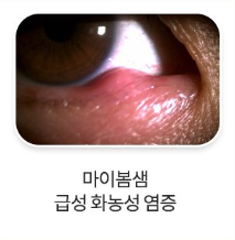 다래끼2